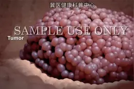 3D动画演示癌症放射治疗过程