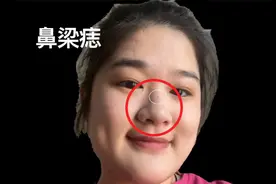 鼻梁的痣有些伤财，财进财出财难聚