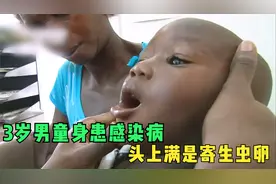 3岁男童身患阴虱感染病，头上满是寄生虫卵，幸好他父母很负责视频封面