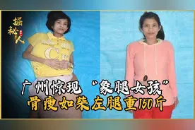 广州惊现“象腿女孩”，骨瘦如柴左腿重150斤，医生切开惊出冷汗视频封面