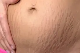 产后妊娠纹如何去？4个居家淡纹妙招！坚持1个月皮肤又嫩又滑！视频封面