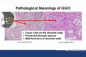 肺磨玻璃结节（GGO）最佳处理策略——东西方观点图片