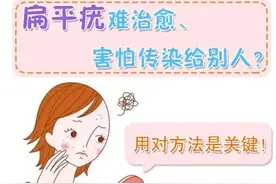 长了扁平疣怎么办，三个方法有效治疗图片