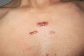 没受伤为什么会长疤痕疙瘩？没有伤口为什么会长疤痕疙瘩？图片