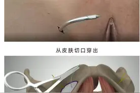 门医科普 | 关于尿失禁手术，你想知道的都在这儿图片