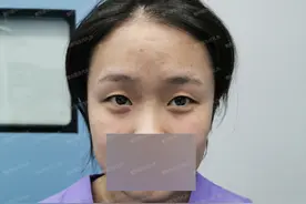 眼窝凹陷的五大原因，根据多年的面诊经验总结，平时要注意预防图片