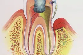 牙齿时痛时不痛为哪般？让专家告诉你！图片