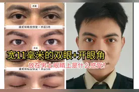 男士双眼皮：昆明奶爸修复11毫米眼皮后，不认识的人都觉他是oo后图片