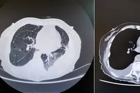 半年3次入院皆因胸闷不适，胸腔积液增多，该从哪个方向找原因？图片