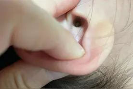 积攒了6年的耵聍，成功为小宝儿掏耳朵图片