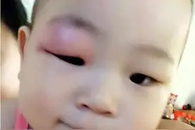 宝宝被蚊子咬后又肿又痒，咋办？宝妈亲测方法有效，完全可以效仿图片