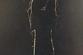 “人老腿先老”！73岁老汉右脚溃烂，必须得截肢？图片