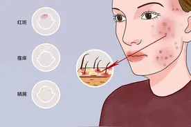 五类用于脂溢性皮炎的药物图片