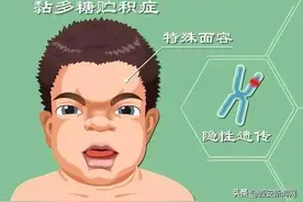 幼童患上黏多糖贮积症II型罕见病 医院开展特异性酶替代治疗获成功图片