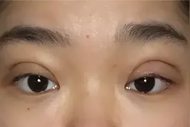 三甲医院整形医生：人造双眼皮和天生双眼皮究竟差在哪？图片