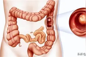 为什么肠道容易长“息肉”？肠内若有息肉，身体会有什么症状？图片