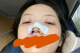 “冰柠檬”自曝遭妈妈家暴，鼻子淤青眼含泪光，火速删文引人担忧图片