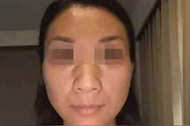 39岁唐女士做完大切口拉皮，一照镜子吓坏了，2个月恢复成了这样图片