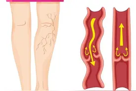 腿胀、腿痒、腿酸？可能是静脉曲张的早期信号！四个办法帮你缓解图片