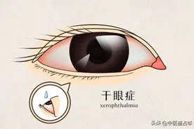 眼科“绝症”？治不好的干眼症，中医只需一招，还你明亮双眼图片