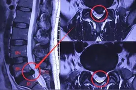 出现腰5骶1椎间盘突出怎么办图片