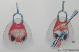 鼻部皮肤软组织过厚，要怎样做出精致秀气的鼻头？图片