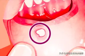 体内有癌，嘴巴先知？口腔出现5种迹象，可能是癌细胞“活跃”图片