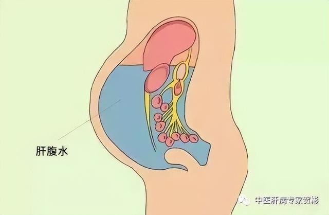 肝硬化腹水能治愈吗？记住这几点，治愈不是梦
