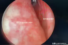 前列腺增生手术有风险，是否不应该做手术？从百年手术发展来思考图片