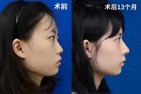 做鼻基底填充，真的会影响表情吗？图片