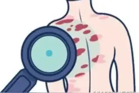 身上长红斑不痛不痒表皮脱皮怎么办图片