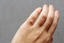 身上这种“小疙瘩”，千万别乱抠，小心癌变！要引起重视图片