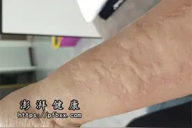 身上痒特别是在晚上越抓越痒是什么原因导致的，预示什么疾病？图片