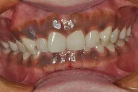 牙龈发黑是什么疾病！提醒：这些东西要停用图片