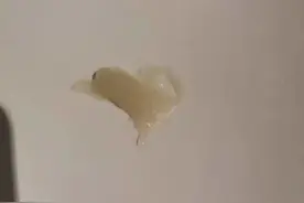 当哮喘患者咳出果冻样、啫喱样，甚至是长条形痰栓，究竟怎么了？图片