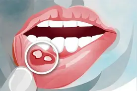 口腔溃疡很常见，如何预防与治疗？图片