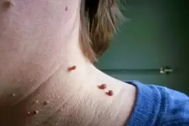 脖子、腋下长“小肉球”，是HPV感染？会癌变？千万别乱抠图片