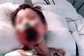 揪心！石家庄10岁女童身上涂火碱去玩水，全身40%重度烧伤图片