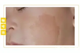 身上有咖啡斑可以治疗吗？图片
