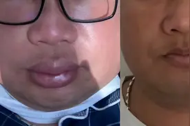 身体像被吹大一圈，每年发作好几次！华山医院变态反应科为罕见病患者开出新药沪上医保首方图片