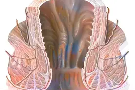 什么是肛瘘？肛瘘与痔疮有哪些不同？肛瘘手术，到底有多痛？图片