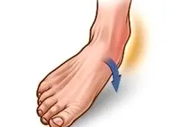 踝关节外侧韧带损伤临床病例报告图片