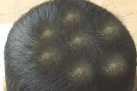 为啥有的孩子会有“2个头旋”？与命运有何联系？科学答案了解下图片