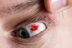 如果你的眼睛布满血丝，可能是这种严重情况的征兆，不要忽视图片