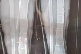 胫腓开放性骨折康复之路图片