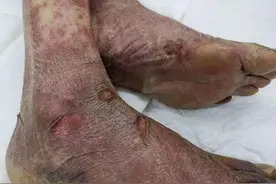 心疼！2年间挺过多次癌症手术的他，却因不起眼的皮疹，住进DICU……图片