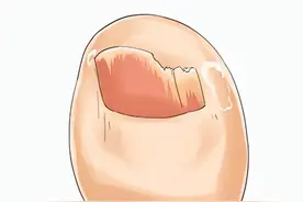 “小脚趾甲分成“两瓣”的才是纯汉族人”，这种说法靠谱吗？图片