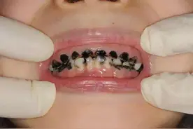 从不给孩子吃糖，为何5岁男孩却满嘴烂牙？原因出在家长身上图片