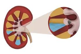 查出肾结石后，多喝可乐可以打结石，是真的吗？带你了解真相图片