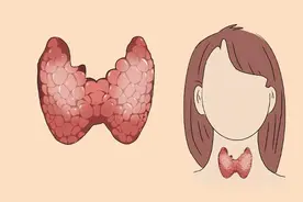 甲状腺结节4a类严重吗？需要手术吗？速看→4a级结节怎么处理图片